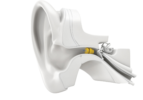 draadloos Stationair Probleem The discreet hearing solution that's fit and forget!