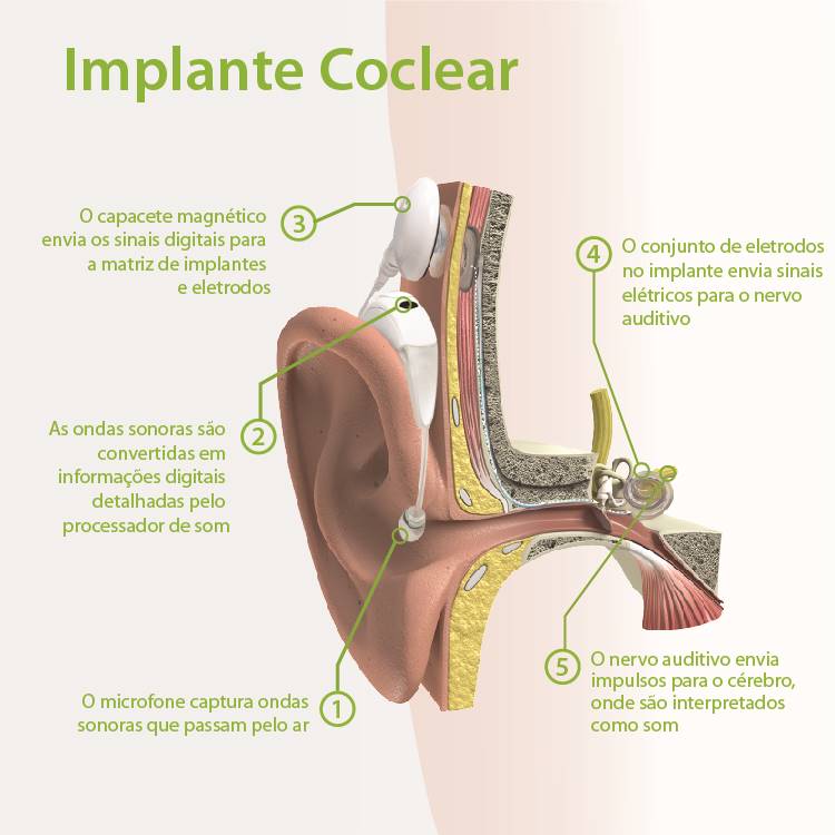 Gráfico de um implante coclear inserido