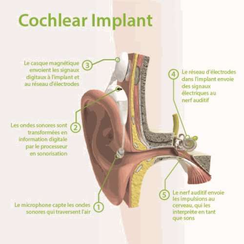 Illustration d’un implant cochléaire placé