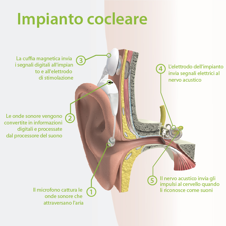 Informazioni Sull impianto Cocleare AudioNova